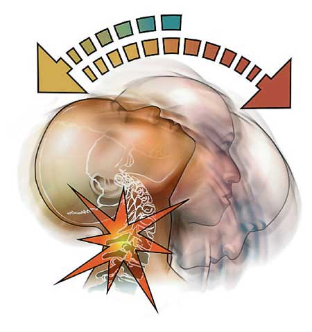 : Diagram of how whiplash occurs that may be the cause of neck pain.
