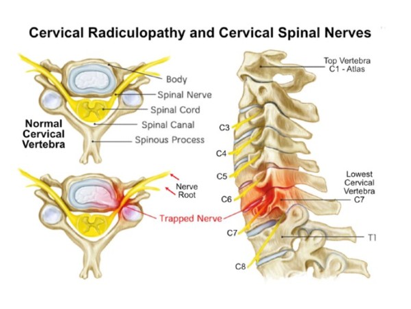 An anatomical diagram showing cervical radiculopathy and cervical spinal nerves that can become trapped, leading to neck pain and restricted movement.